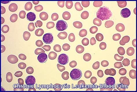 Chronic Lymphocytic Leukemia Ask Hematologist Understand Hematology