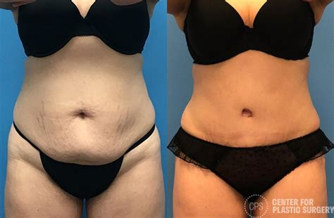 Tummy Tuck Before After Photos Patient 56 Chevy Chase Annandale