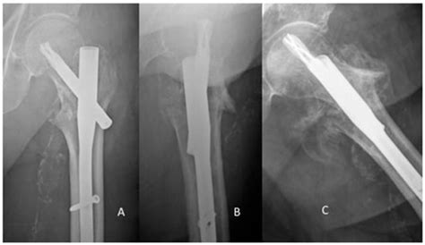 Jcm Free Full Text Migration Of The Lag Screw After Intramedullary