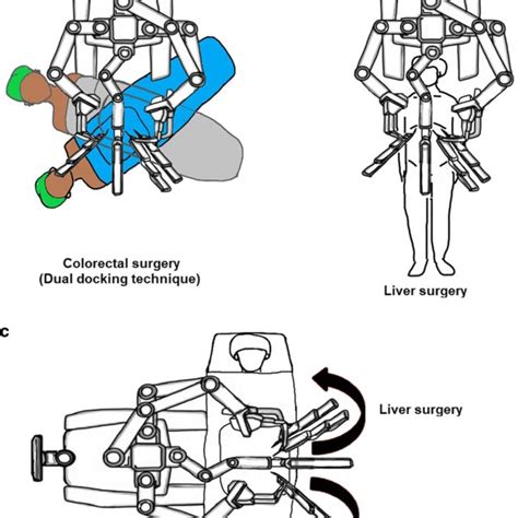 Trocar Placement For Robotic Simultaneous Liver And Colorectal Download Scientific Diagram