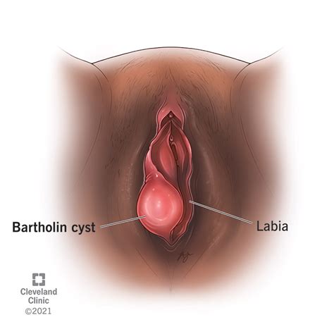 Bartholin Cyst Definition Symptoms Causes Treatment Pictures Hot Sex