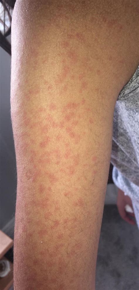 Skin Rash Should Be Considered As A Fourth Key Sign Of Covid 19
