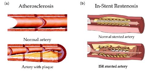 Atherosclerosis Of Blood Vessels And In Stents Restenosis A