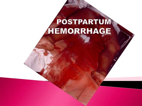 Postpartum Hemorrhage Causes Risks The Top 10 Warning