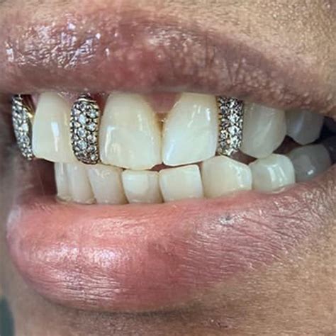 Dimond Grillz Gold Teeth Master