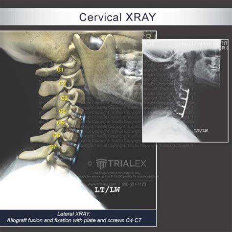 Cervical Xray Trialexhibits Inc