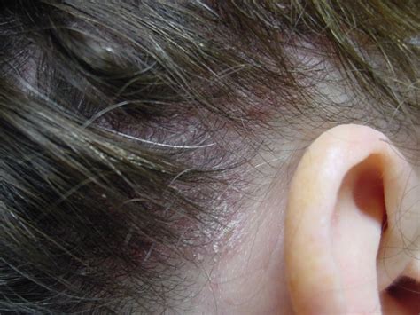 A novel clinical form consequent to. Schimmelinfecties van de huid (patientenfolder)