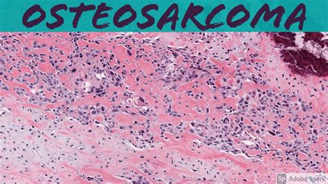 Osteosarcoma 101 Bone Pathology Basics Youtube