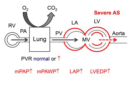 Hemodynamics Of Severe Aortic Stenosis As There Is Pressure Overload