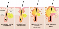 Sebaceous Glands - Location, Functions and Pictures