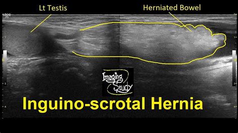 Testicular Hernia Ultrasound