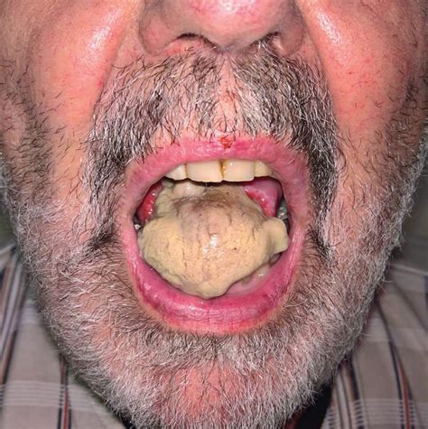 Tongue Necrosis Due To Giant Cell Arteritis Gca Medizzy Journal