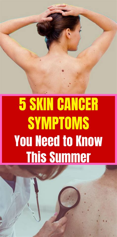5 Skin Cancer Symptoms You Need To Know This Summer Passionofswathi