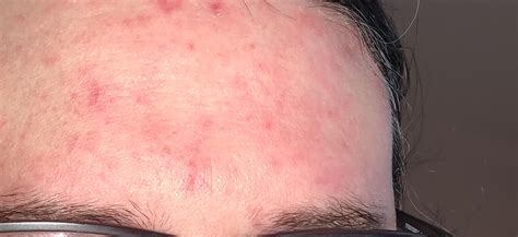 Skin Concerns Red Forehead And Scalp Sores That Never Completely Heal