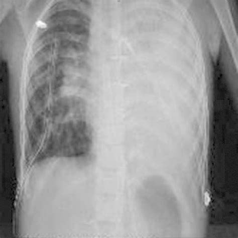 Chest X Rays Of The Patient Showing A Tension Pneumothorax On The Left