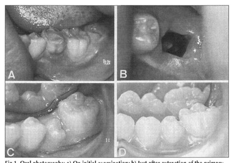 Figure 1 From Eruption Of An Impacted Second Premolar After