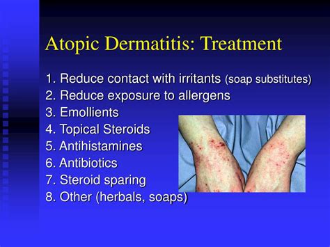 Ppt Atopic Dermatitis Powerpoint Presentation Free Download Id4929119