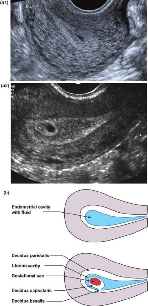 A Transvaginal Ultrasound Images Showing Pseudosac And True