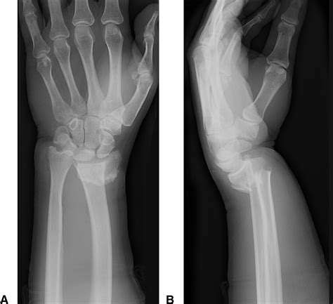 Dorsal Displacement Of The Ulnar Nerve After A Displaced Distal Radius