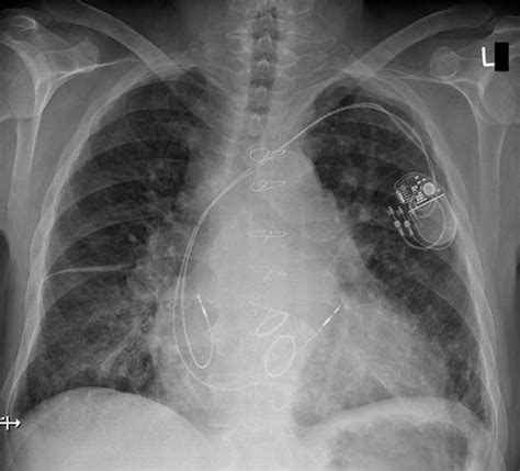 Prosthetic Heart Valves On Chest X Ray How Can You Reliab Flickr