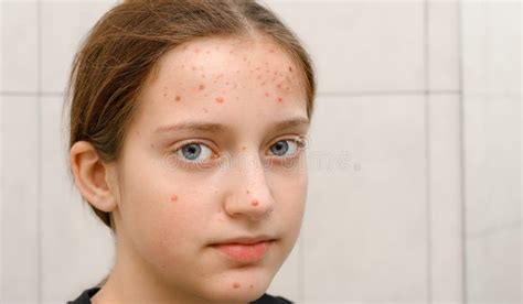 Face Of A Teenage Girl With Pimples Acne On The Skin Portrait Of