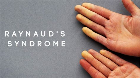All You Need To Know About Raynauds Syndrome