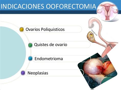 Oforosalgingectomia Jonathan Molina