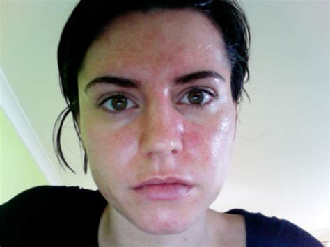 Blotchy Skin Face Dorothee Padraig South West Skin Health Care