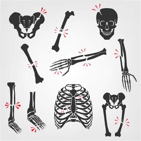 Broken Bone Illustrations Royalty Free Vector Graphics And Clip Art Istock