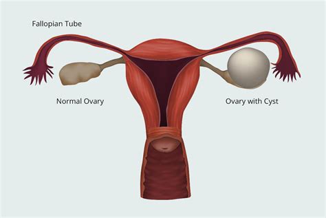 ovarian cysts singapore ovarian cyst removal gynaemd