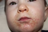 What Causes Rashes Around Your Toddlers' Mouth? - New Kids Center