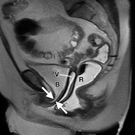 Pelvic Floor Failure MR Imaging Evaluation Of Anatomic And Functional Abnormalities RadioGraphics