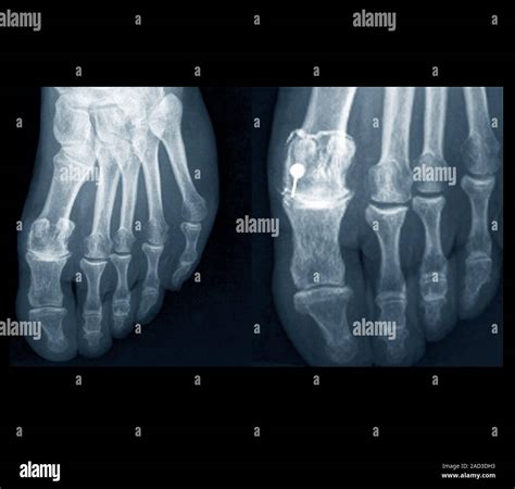 Osteoarthritis Of The Foot X Rays Of The Left Foot Of A 75 Year Old
