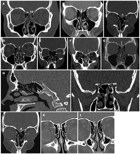 Computed Tomography Scans Of Paranasal Sinuses Before Functional