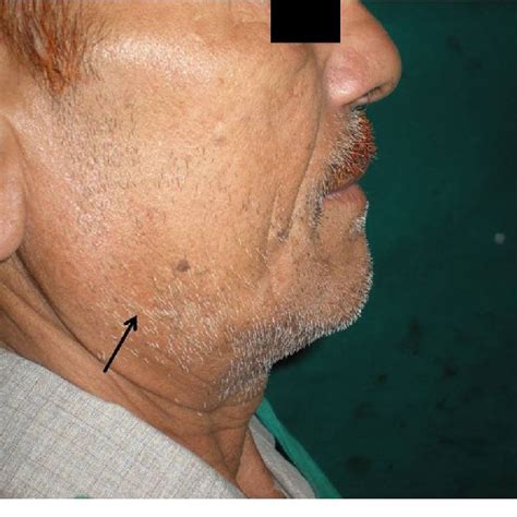 Front View Showing Diffuse Submandibular Swelling On Right Side Of Face