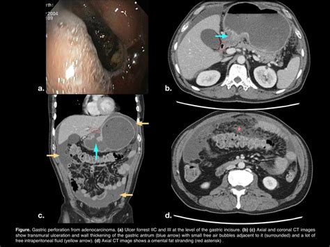Perforation Of Gastric Cancer Serau Sociedad Española De Radiología