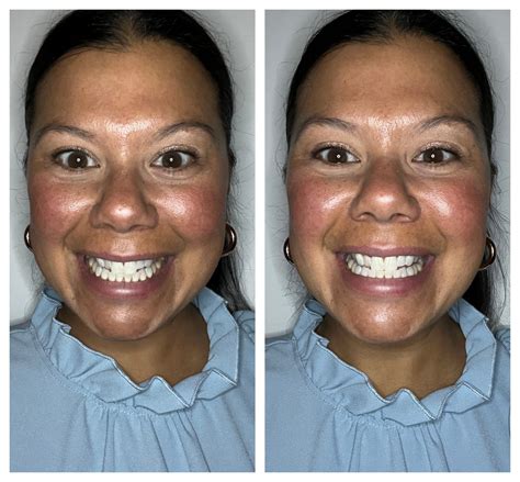 We Tried 5 Common Enamel Whiteners Bellejamaica