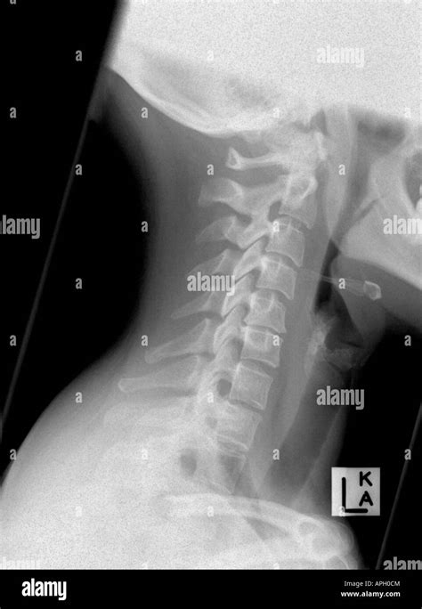 Lateral X Ray Of A Cervical Spine Neck Showing Spasm But No Stock