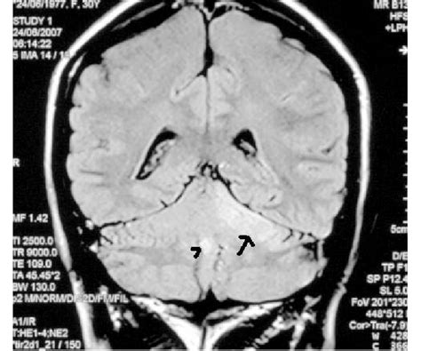 Mri Brain Coronal Flair Image Showing Acute Infarction Of Left