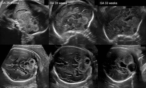 Serial Antenatal Fetal Ultrasonography Obtained For The Screening Test