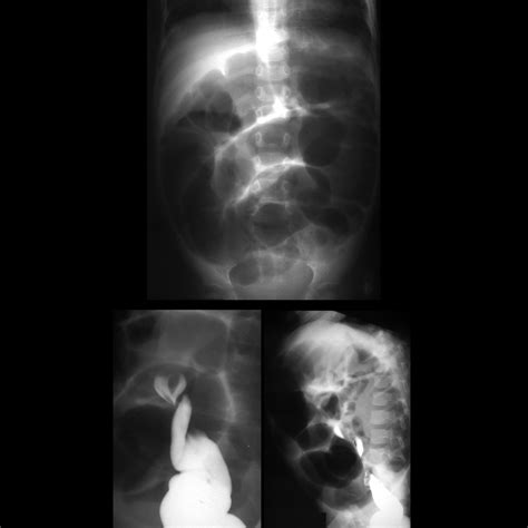 Pediatric Sigmoid Volvulus Pediatric Radiology Reference Article