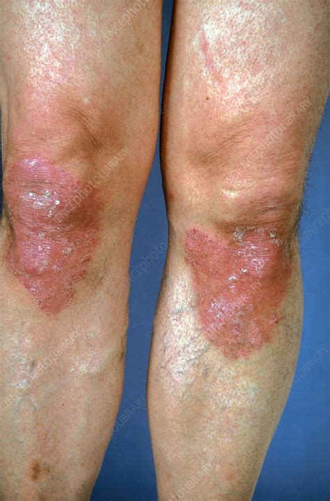 Psoriasis Affecting Both Knees Stock Image M2400007 Science
