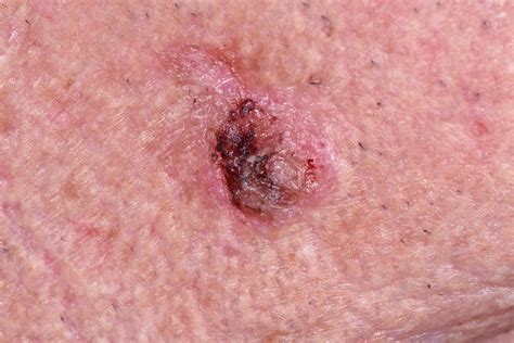 Squamous Cell Carcinoma Skin Cancer Stock Image C0345457 Science