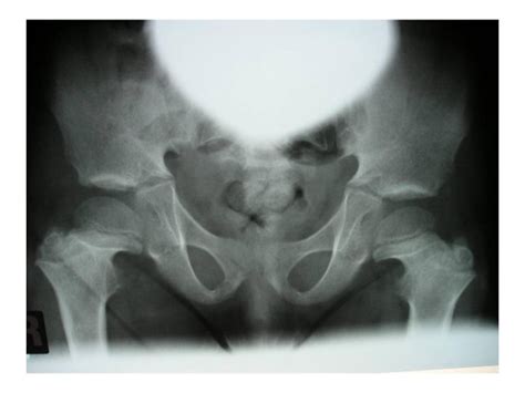 Anteroposterior Radiograph Of The Pelvis Showing Rounded Iliac Bones A
