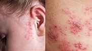 10 Rashes That Could Reveal a Dermatologic Disease » | Types of rashes ...