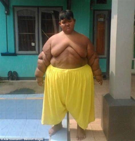 Worlds Fattest Boy In Indonesia Sheds Half His Body Weight Daily