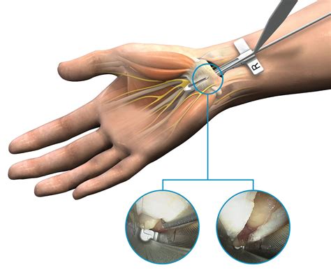 Endoscopic Release For Carpal Tunnel Syndrome Captions Trendy