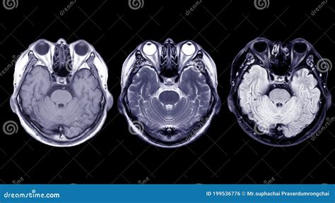 Compare Mri Of The Brain Axial T1 T2 And T2 Flair Stock Illustration