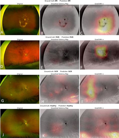 Deep Learning Based Classification Of Retinal Vascular Diseases Using