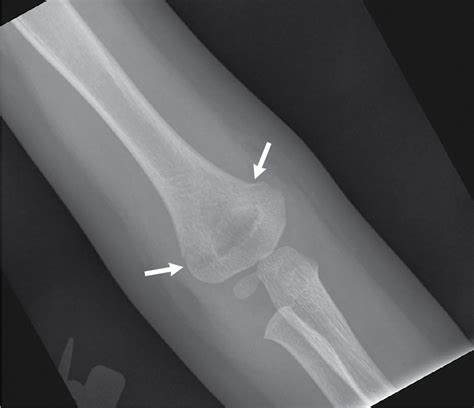 My Fracture Is Not Humerus Supracondylar Fractures Radiology Key